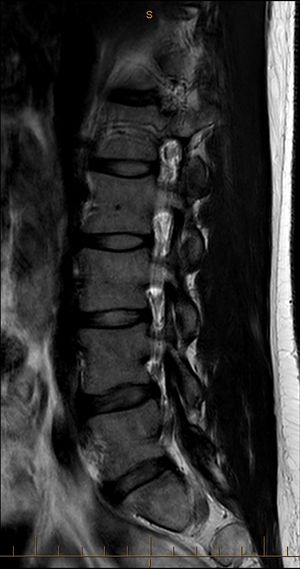 MRI T2 Lumbar Spine Sagittal Transpedicular.jpg