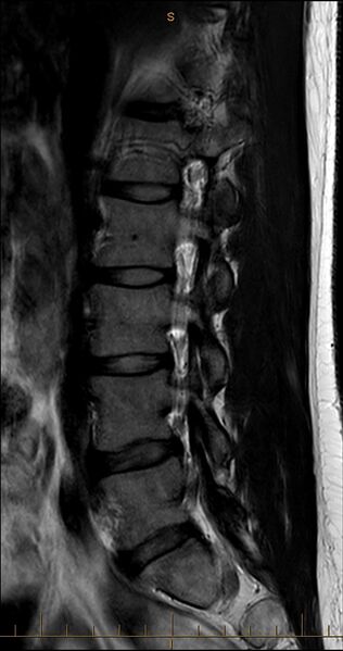 File:MRI T2 Lumbar Spine Sagittal Transpedicular.jpg