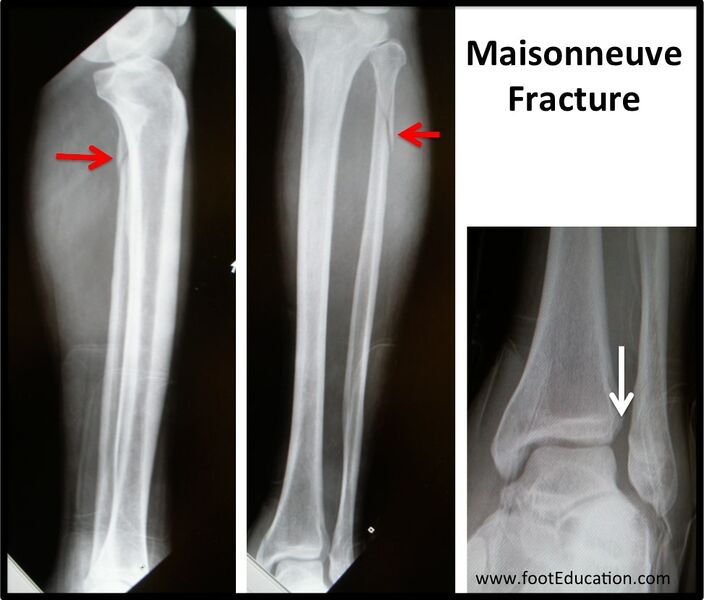 File:Maisonneuve fracture.jpg