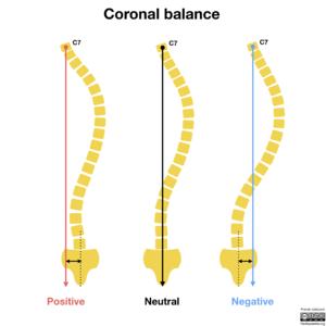 Coronal-balance-spine.png