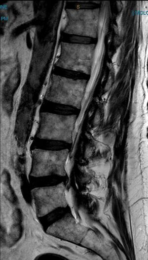 Leg pain case 001 MRI Lumbar Spine Sagittal Paramedian.jpg