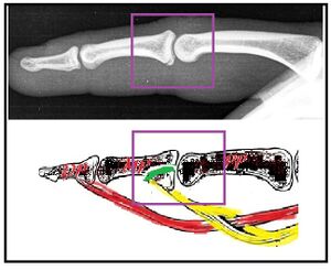Superficial flexor tendon intra-articular fragment.jpg