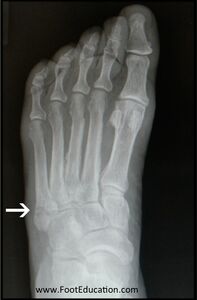 Figure 4: Radiograph of Dancer’s Fracture (Avulsion Fracture) - Zone 1 of 5th Metatarsal