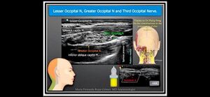 Greater occipital nerve block ultrasound.jpg