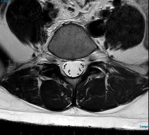 MRI T2 Lumbar Spine L5 Subpedicular Axial.jpg