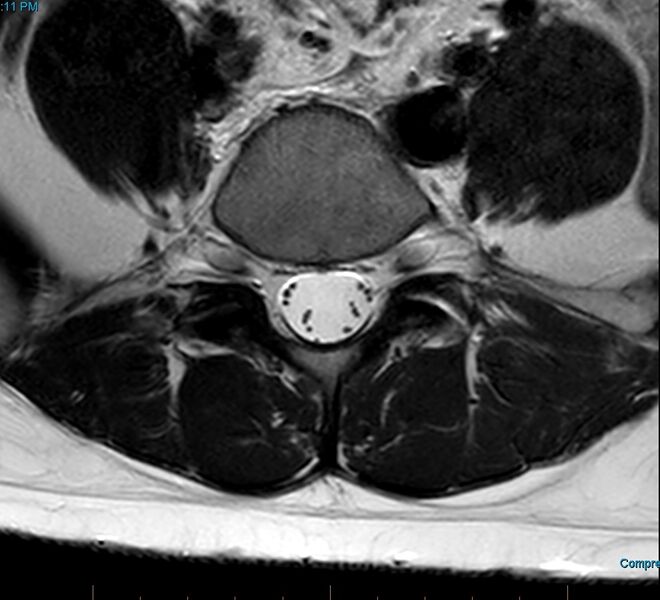 File:MRI T2 Lumbar Spine L5 Subpedicular Axial.jpg