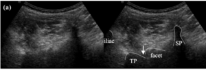 TDR ultrasound.PNG