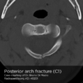 Posterior neural arch fracture