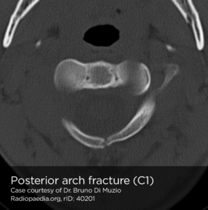 Posterior arch fracture.png