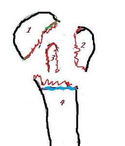 Figure 5: A “four-part” fracture