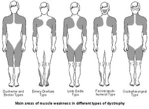 Muscular dystrophy weakness patterns.jpg