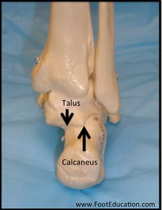Figure 2: Lateral Offset of Calcaneus on Talus