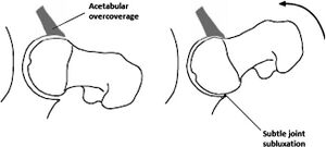 Pincer impingement. There is acetabular over-coverage, and the femoral neck abuts against the labrum, damaging it as well as the underlying cartilage. With continued hip flexion there is subtle joint subluxation and a contre-coup lesion forms. There is delamination of the labrum from the acetabular cartilage.[1]
