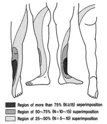 L4 block pattern: Extending from the midline of the trunk posteriorly, across the buttock, through the lateral and anterior side of the thigh and the medial side of the leg to the first digit of the foot.