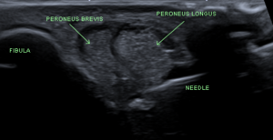 Peroneal tendon sheath injection ultrasound.PNG