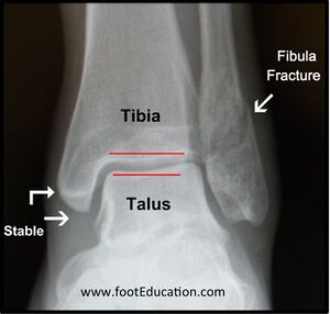 Figure 3: Plain X-Ray of a Stable Ankle Fracture. Note the mortise is intact: the space surrounding the talus is normal.