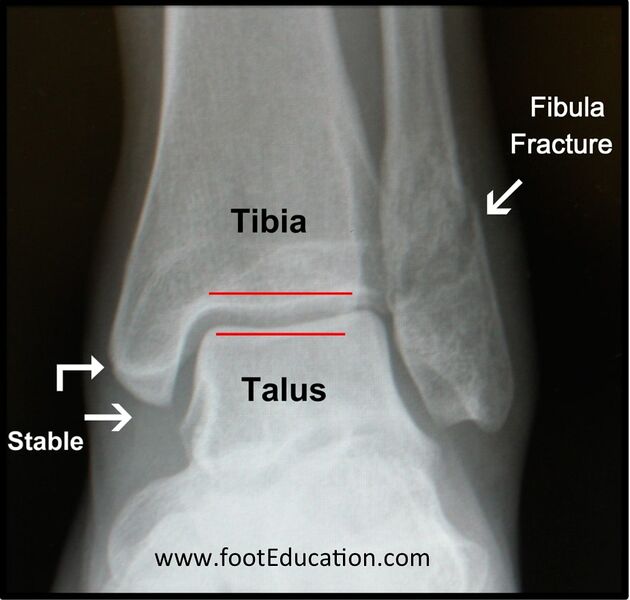 File:Ankle fracture stable.jpg