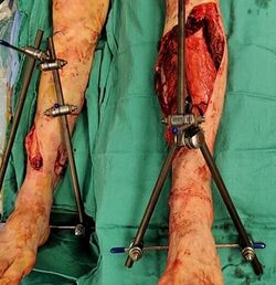 Figure 6: Bilateral external fixators are used here to temporarily stabilize bilaterally open tibia fractures. (courtesy of Jaimo Ahn, MD, PhD, FACS, FAAOS, Harold W. and Helen L. Gehring Research Professor of Orthopaedic Surgery, University of Michigan)