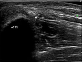 Transverse ultrasound image shows the nerve passing under the inguinal ligament. ASIS: anterior superior iliac spine; LFCN: lateral femoral cutaneous nerve; IL: inguinal ligament.[2]