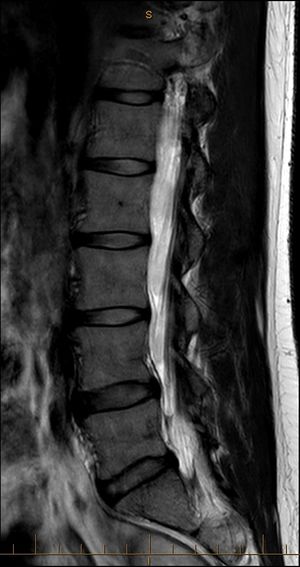 MRI T2 Lumbar Spine Sagittal Paramedian.jpg
