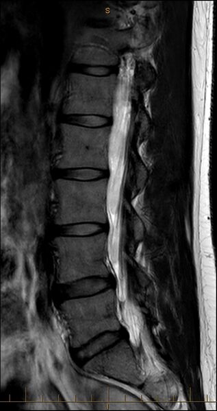 File:MRI T2 Lumbar Spine Sagittal Paramedian.jpg