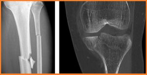 Tibial shaft comminuted fracture.jpg