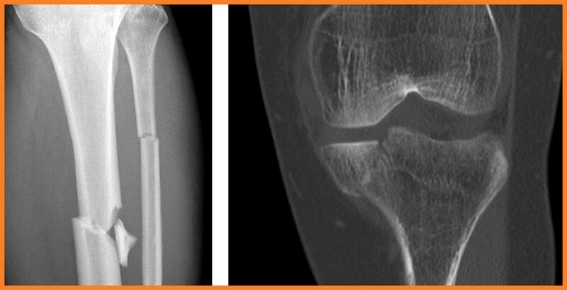 File:Tibial shaft comminuted fracture.jpg