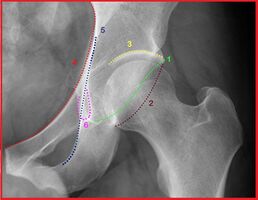 Figure 3: AP x-ray of the pelvis including the articulation between the proximal femur and acetabulum (hip joint) with annotated anatomic landmarks. 1) Anterior acetabular wall; 2) posterior acetabular wall; 3) acetabular roof; 4) iliopectineal line; 5) ilioischial line; and 6) radiographic “tear drop,” representing the thickness between the external and internal aspects of the acetabular walls.