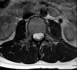 MRI T2 Lumbar Spine L3 Transpedicular Axial.jpg