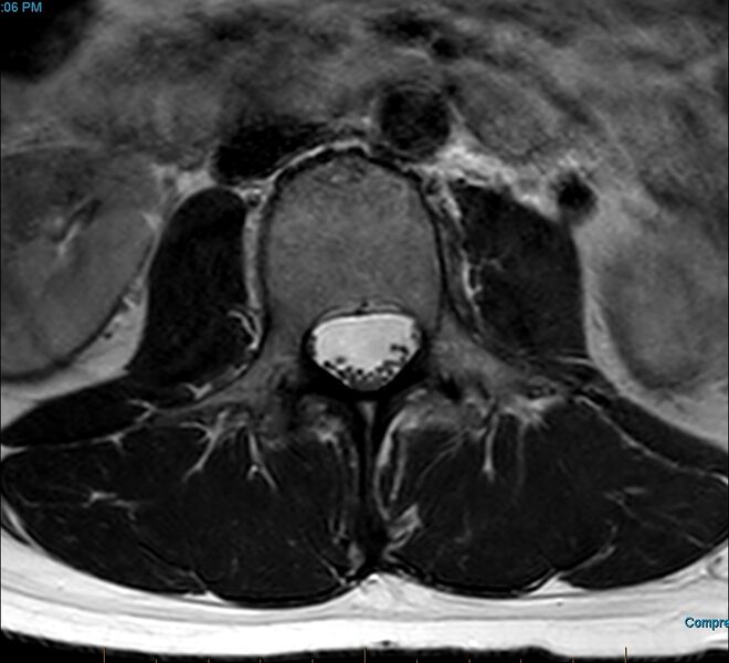 File:MRI T2 Lumbar Spine L3 Transpedicular Axial.jpg