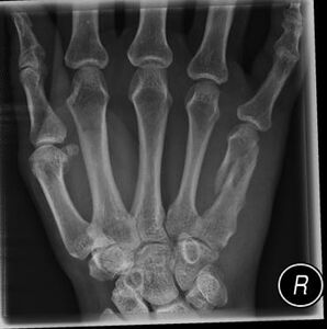 Figure 3: Fracture of the shaft of the 5th metacarpal.