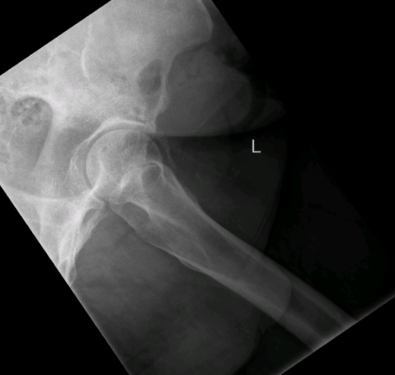 Leg pain case 001 L hip lateral.png