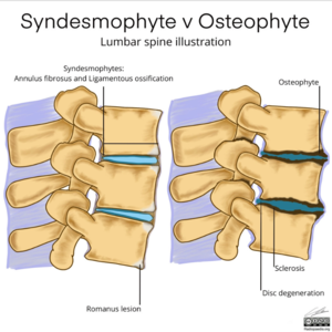 Syndesmophyte vs Osteophyte.PNG