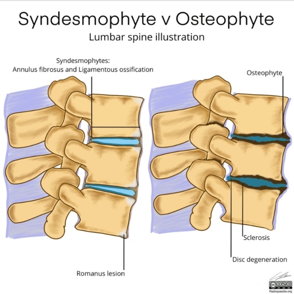 File:Syndesmophyte vs Osteophyte.PNG