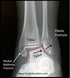 Figure 4: Plain X-Ray of an Unstable Ankle Fracture. Note how the talus is displaced laterally along with the fibular fragment and no longer sits snugly within the distorted mortise.