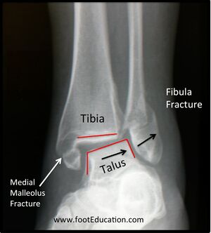 Ankle fracture unstable.jpg