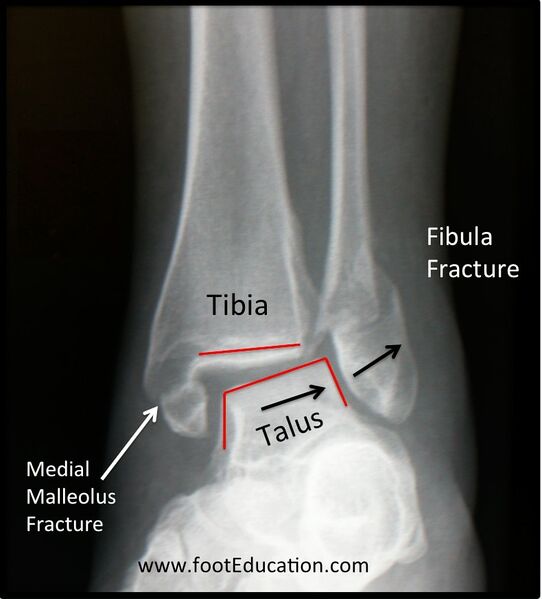 File:Ankle fracture unstable.jpg