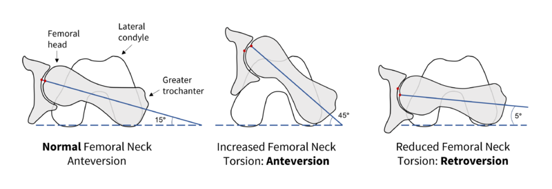 File:Femoral neck torsion.png
