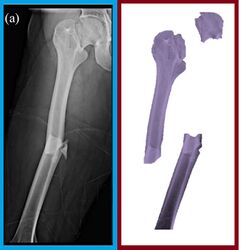 Figure 4: Shown at left is an x-ray of a femur with two concomitant fractures: the more obvious fracture of the shaft and a more subtle but visible fracture of the neck. These fracture lines may be easier to appreciate on the schematic to the right, in which the fragments are shown distinctly. (X-ray courtesy of Ipsilateral femoral neck and shaft fractures fixation with proximal femoral nail antirotation II (PFNA II): technical note and cases series. J Orthop Surg Res 15, 20 (2020))