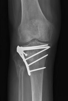 Figure 7: ORIF of a tibial plateau fracture with a plate and screws. (courtesy of Jaimo Ahn)