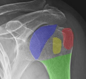 Figure 2: An x-ray highlighting the articular surface (blue), greater tuberosity (red), lesser tuberosity (yellow) and humeral shaft (green).
