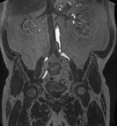Leg pain case 001 MRI angiogram.png