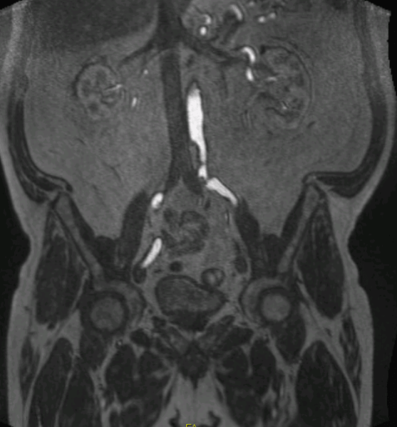 File:Leg pain case 001 MRI angiogram.png
