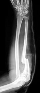 Figure 3: X-ray of a Monteggia fracture.