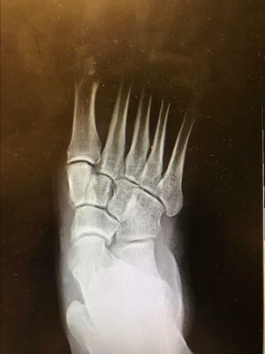 Adult Acquired Flatfoot Radiograph.jpg