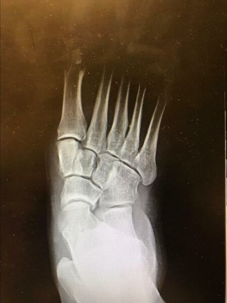 File:Adult Acquired Flatfoot Radiograph.jpg