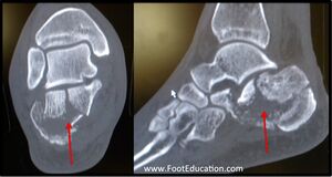 Figure 10: CT Scan of Calcaneus Fracture: Coronal View (left), Sagittal View (right)