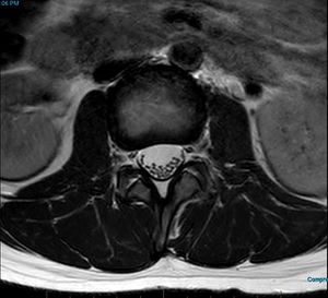 MRI T2 Lumbar Spine L2-L3 Transarticular Axial.jpg