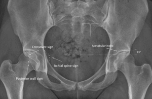 Crossover posterior wall and ischial spine signs xray.png