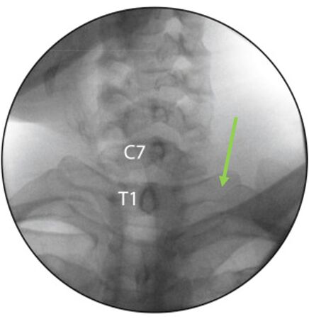 Fluoroscopic AP view of the cervicothoracic junction. Compare the upward sloping and longer transverse processes of T1 with the shorter and downward sloping transverse processes of C7
